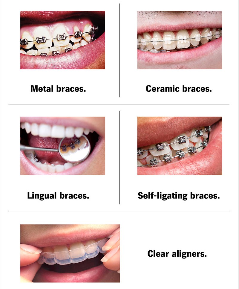 Teeth Braces
